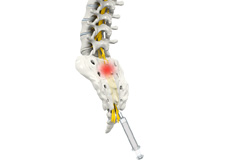 Spine Injections