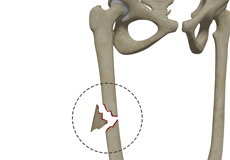 Femoral Shaft Fracture