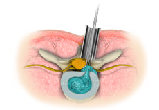 Minimal Exposure Tubular Retractor (METRx) System