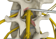 Nerve and Spinal Decompression Surgery