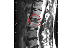 Pathological Fractures of the Spine