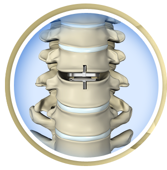 Cervical Disc replacement