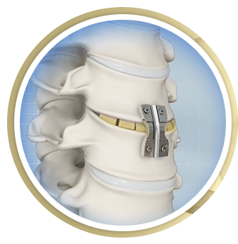 Discectomy and Fusion