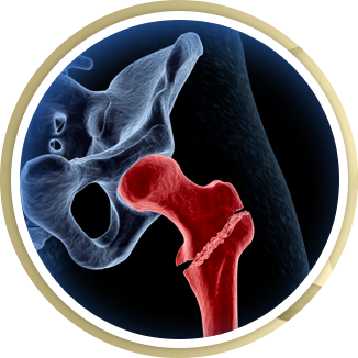 Fracture Reconstruction