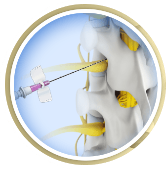 Spinal Injections