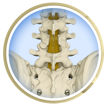 Laminectomy