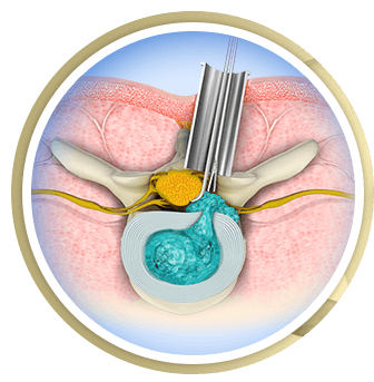 Minimally Invasive Spine Surgery
