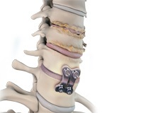 Adjacent Segment Disc Disease