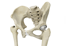 Anterior Hip Replacement