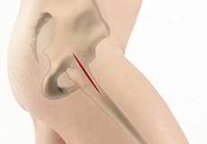 Outpatient Hip Replacement