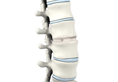 Lumbar Fusion