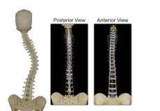 Anterior and Posterior Scoliosis Surgery