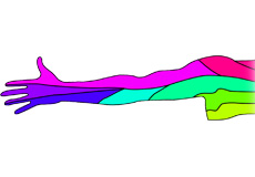 Arm Pain of Spinal Origin