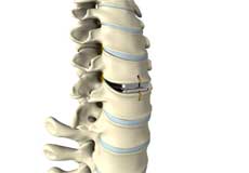 Cervical Arthroplasty