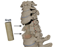 Cervical Corpectomy and Strut Graft