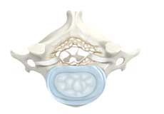 Cervical Degenerative Disc Disease