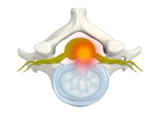 Cervical Disc Protrusion