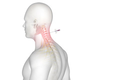 Cervical Epidurals