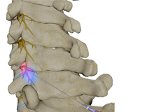 Cervical Facet Blocks