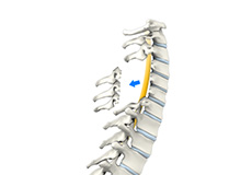 Laminectomy