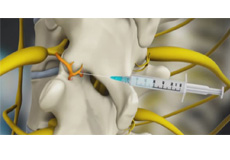 Cervical Medial Branch Block