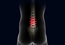 Complications of Spinal Surgery