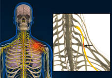 Compression of Thoracic Nerve