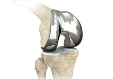 Custom/Patient-Specific Hip Replacement