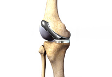 Custom Knee Replacement