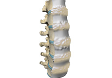 Diffuse Idiopathic Skeletal Hyperostosis