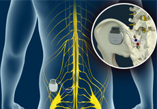 Dorsal Column Stimulator