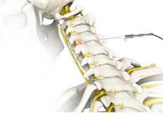 Endoscopic Rhizotomy