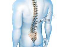 Endoscopic Spine Surgery