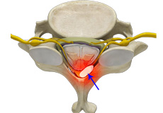 Epidural Abscess