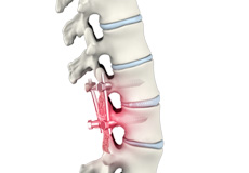 Failed Back Surgery Syndrome