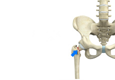 Femoral Neck Fracture