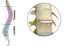 Fracture of the Thoracic and Lumbar Spine