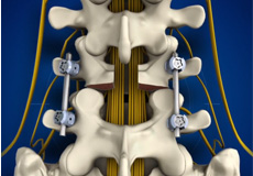 Fracture Stabilization