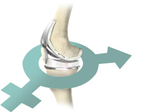 Gender-Specific Knee Replacement