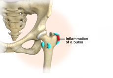 Hip Bursitis