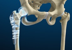 Hip Fracture ORIF