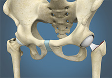 Hip Hemiarthroplasty