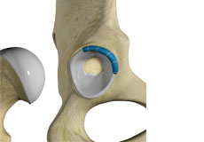 Hip Trauma Reconstruction