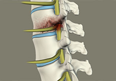 Spinal Infection Decompression