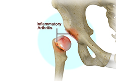 Inflammatory Arthritis of the Hip