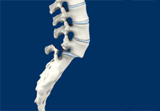 Isthmic spondylolisthesis