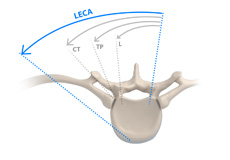 Lateral Extracavitary Approach Surgery