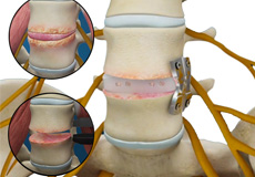 Lateral Lumbar Interbody Fusion