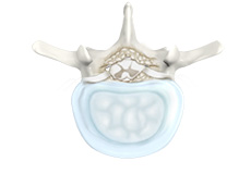 Lumbar Degenerative Disc Disease