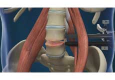 Lumbar Discectomy